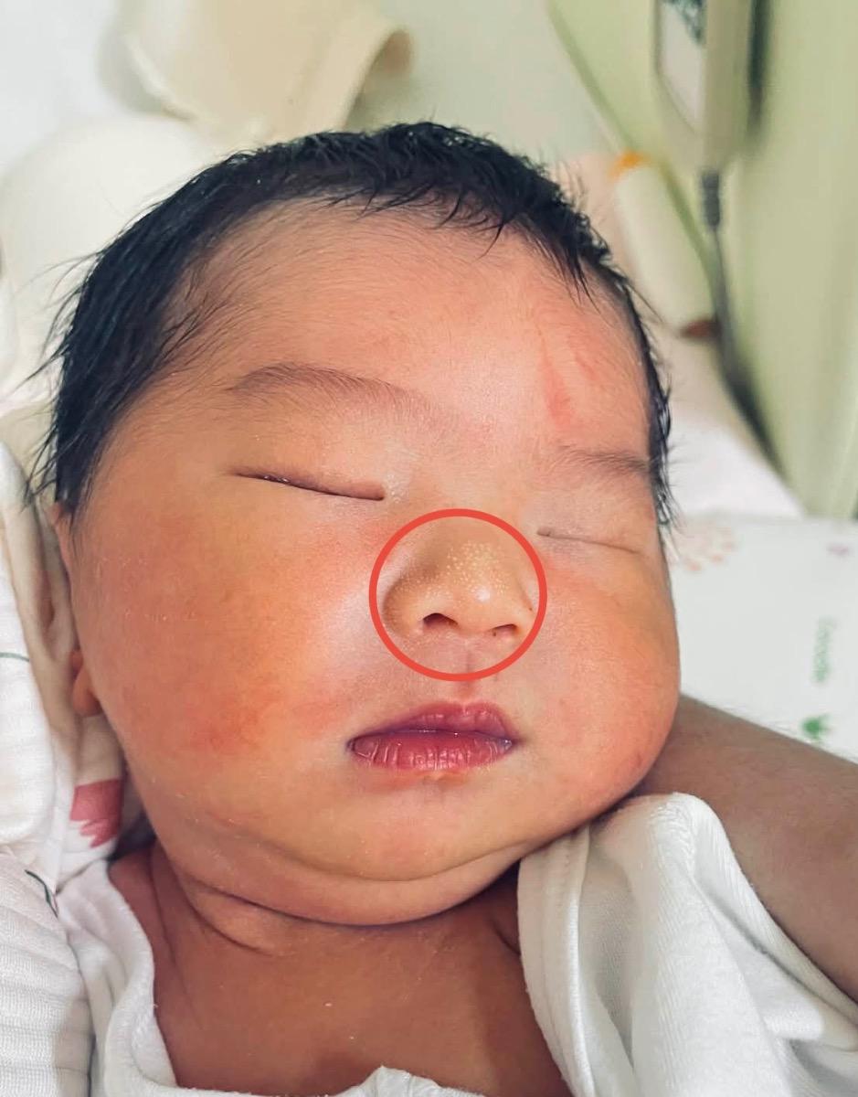 Hiện tại bé được 4 ngày tuổi có xuất hiện đốm trắng nhỏ li ti trên mũi . Làm sao để hết được ạ