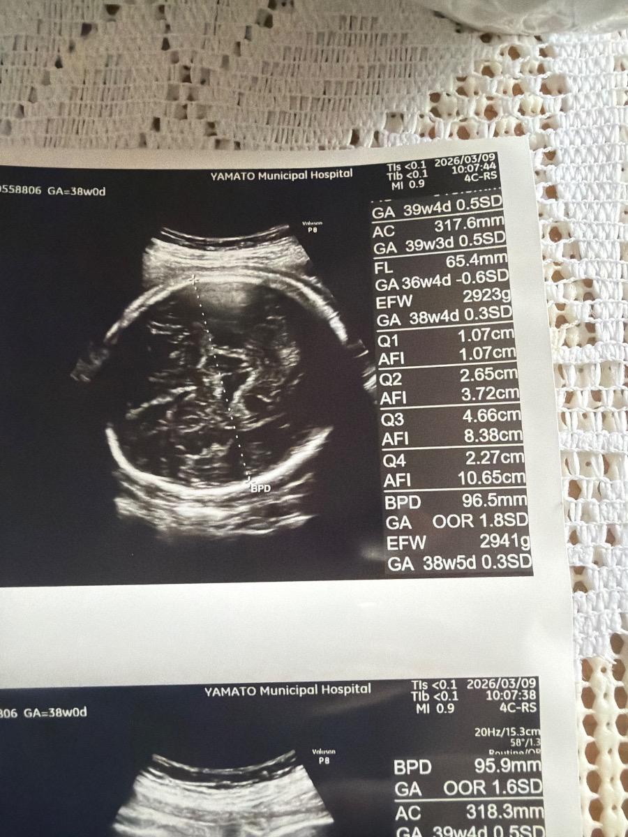 Em đang bầu 38 tuần FL của bé hơi nhỏ hơn so với bình thường thì có đáng lo không ạ