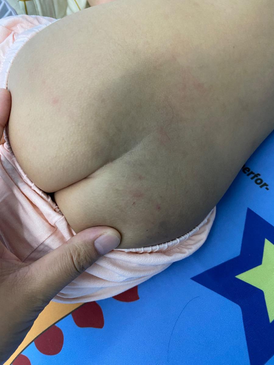 Dạ cho e hỏi bé nhà e nổi mụn nhỏ ở sau lưng và phần mông thì có p do bé nóng ko ạ. E cảm ơn ạ!