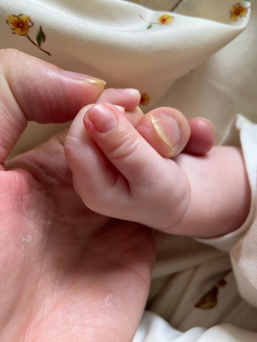 Móng tay của me bị sưng thế này làm sao để khỏi sung ạ! E cắt móng cũng ko có sát mà ko hiểu sao lạo sưng vậy
