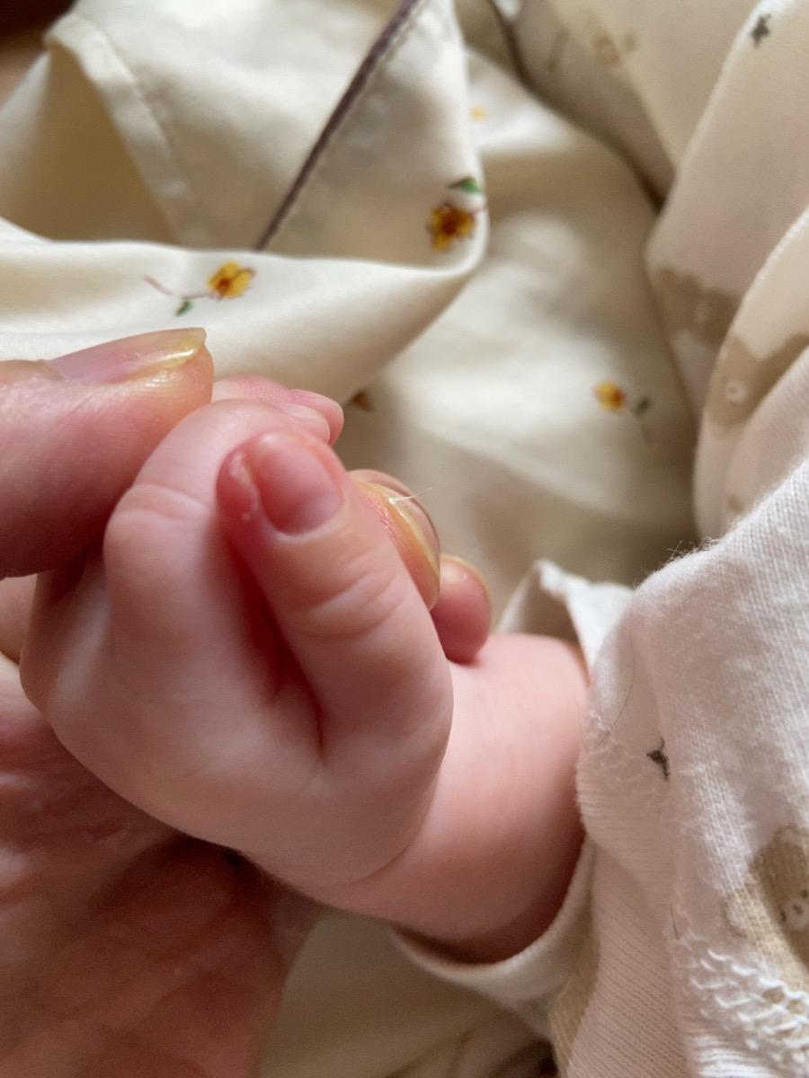 Móng tay của me bị sưng thế này làm sao để khỏi sung ạ! E cắt móng cũng ko có sát mà ko hiểu sao lạo sưng vậy