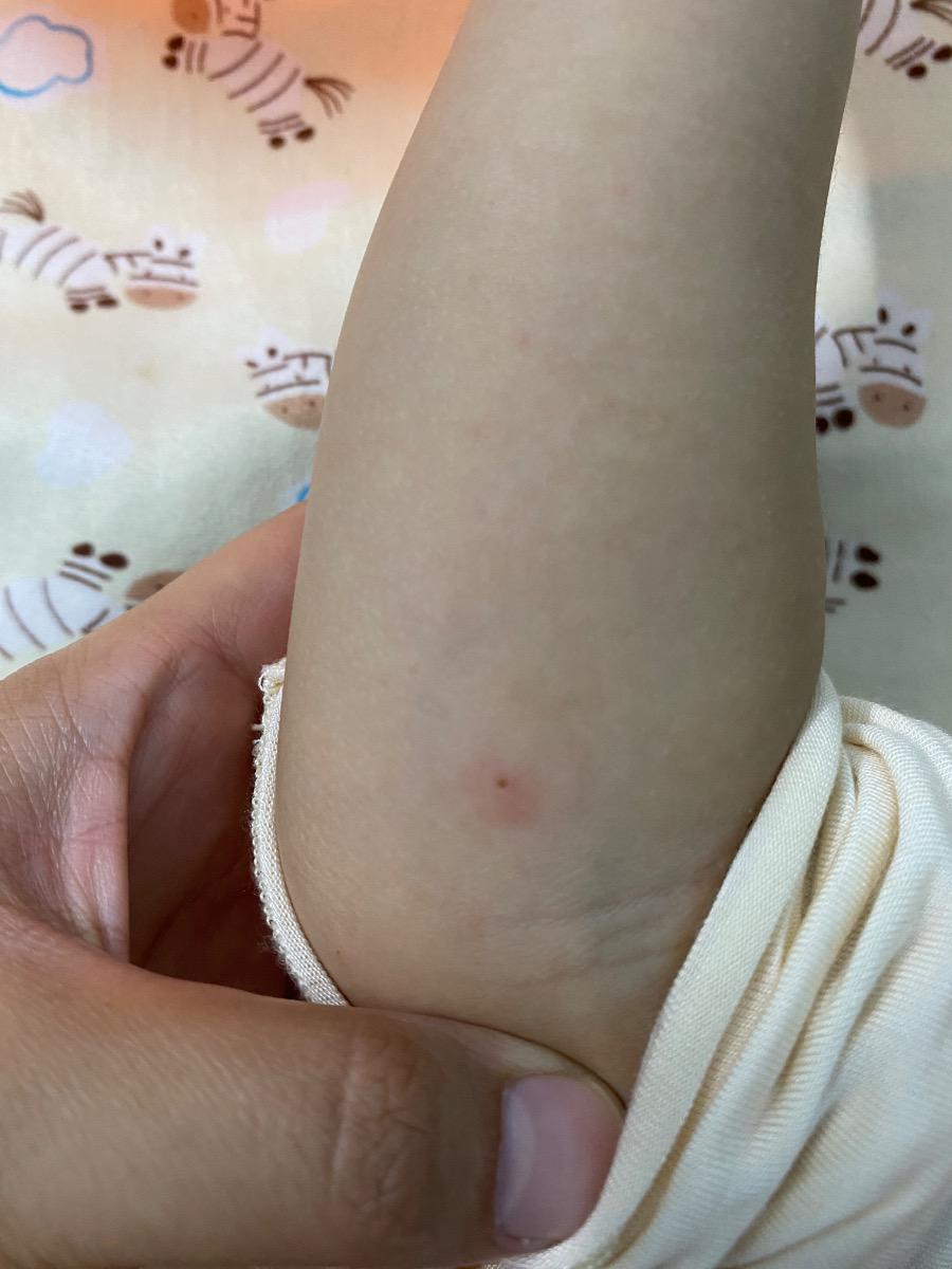 Dạ cho e hỏi bé bị như thế này từ trưa t7 thì có phải bị chân tay miệng k ạ, bé k sốt, k giật mình ạ, trong miệng cũng k có nốt đỏ ạ, tối hqua e xem lòng bàn tay bên phải thì có 2 nốt đỏ ạ, hôm qua bé vừa chích lẹo mắt xong và cho e hỏi nếu bị ctm thì làm cách nào để khỏi mà k cần uống kháng sinh ạ, e cảm ơn ạ. Bao h cần đưa bé đi khám để bs cho thuốc uống ạ, e đọc trên mạng thấy bảo bệnh do virut có thể tự khỏi trong vòng 7-10 ngày ạ, e cảm ơn ạ.