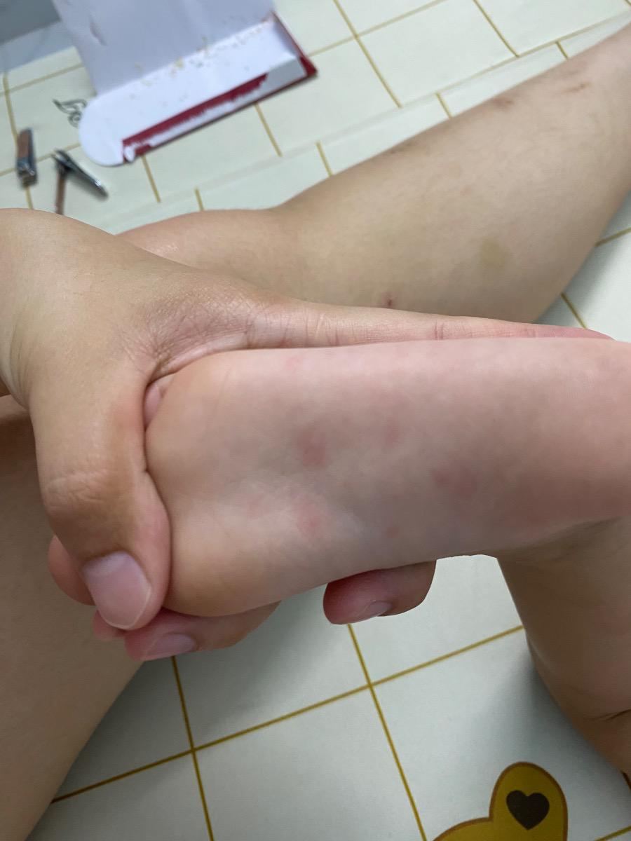 Dạ cho e hỏi bé bị như thế này từ trưa t7 thì có phải bị chân tay miệng k ạ, bé k sốt, k giật mình ạ, trong miệng cũng k có nốt đỏ ạ, tối hqua e xem lòng bàn tay bên phải thì có 2 nốt đỏ ạ, hôm qua bé vừa chích lẹo mắt xong và cho e hỏi nếu bị ctm thì làm cách nào để khỏi mà k cần uống kháng sinh ạ, e cảm ơn ạ. Bao h cần đưa bé đi khám để bs cho thuốc uống ạ, e đọc trên mạng thấy bảo bệnh do virut có thể tự khỏi trong vòng 7-10 ngày ạ, e cảm ơn ạ.