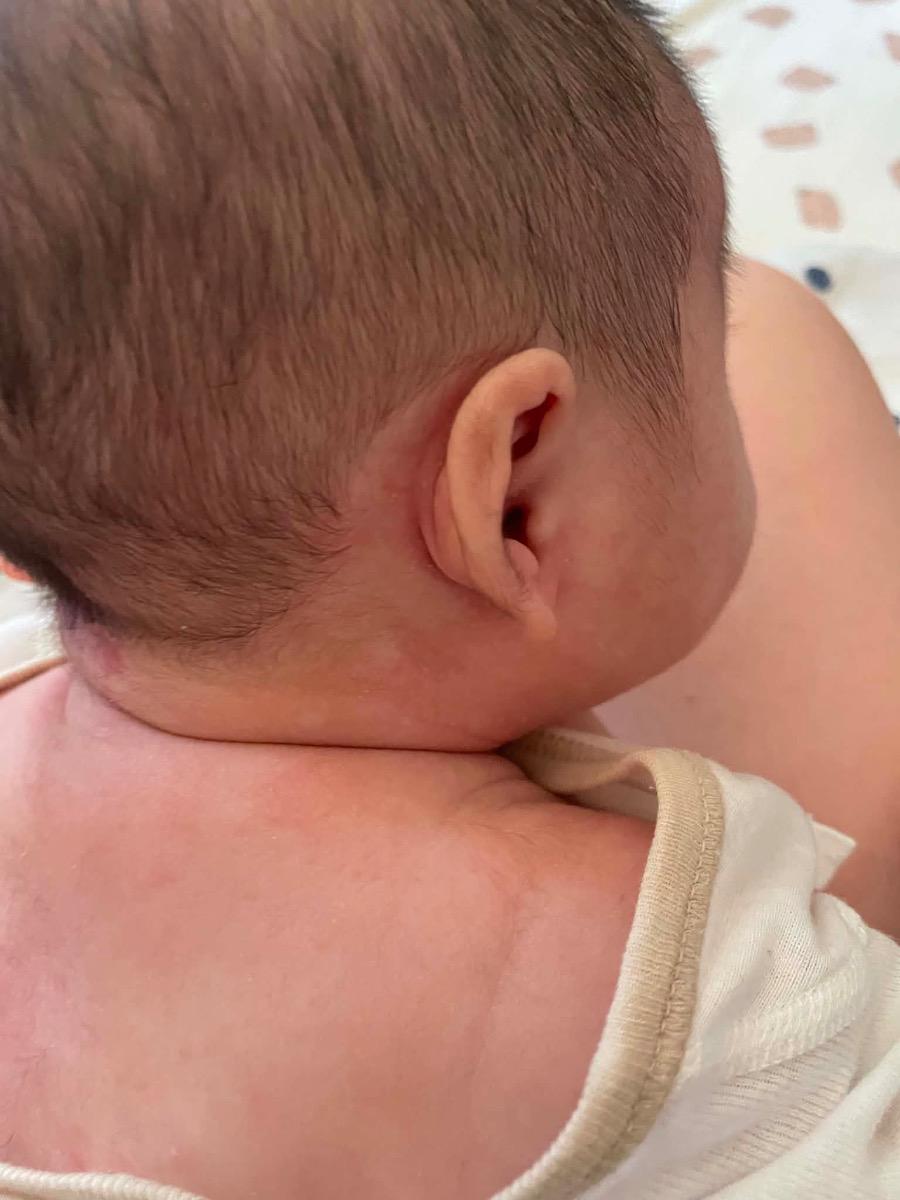 Em hơn 2 tháng tuổi cổ em nhìn có các vết trắng là bị sao vậy ạ