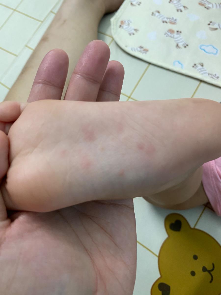 Dạ cho e hỏi bé bị như thế này từ trưa t7 thì có phải bị chân tay miệng k ạ, bé k sốt, k giật mình ạ, trong miệng cũng k có nốt đỏ ạ, tối hqua e xem lòng bàn tay bên phải thì có 2 nốt đỏ ạ, hôm qua bé vừa chích lẹo mắt xong và cho e hỏi nếu bị ctm thì làm cách nào để khỏi mà k cần uống kháng sinh ạ, e cảm ơn ạ. Bao h cần đưa bé đi khám để bs cho thuốc uống ạ, e đọc trên mạng thấy bảo bệnh do virut có thể tự khỏi trong vòng 7-10 ngày ạ, e cảm ơn ạ.